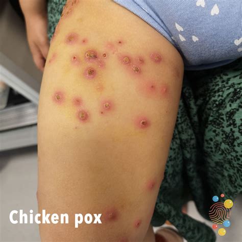 Adult Chicken Pox Stages
