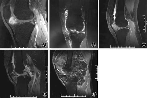 A New Simple And Practical Clinical Classification For Tenosynovial