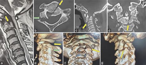 An Atypical Hangmans Fracture With Atlantoaxial Instability
