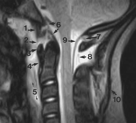 Mr Imaging Findings In Spinal Ligamentous Injury Ajr