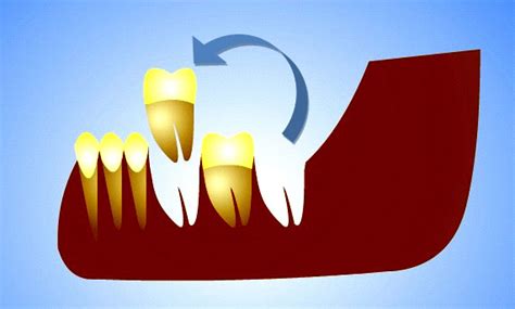 How To Do Tooth Autotransplantation And Why News Dentagama