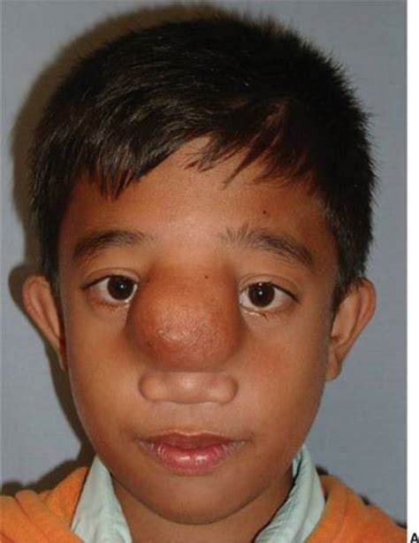 Craniofacial Clefts And Hypertelorbitism Grabb And Smiths Plastic