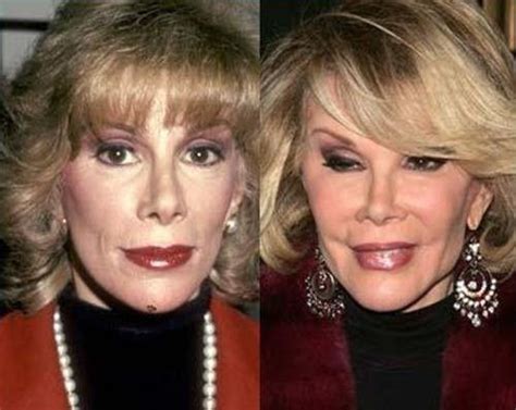 Joan Rivers A Before And After Bad Celebrity Plastic Surgery