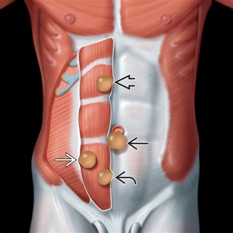 Abdominal Hernia Pictures Infinings