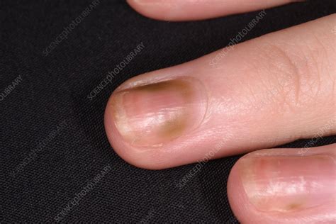 Dystrophic Nails Stock Image C056 4394 Science Photo Library