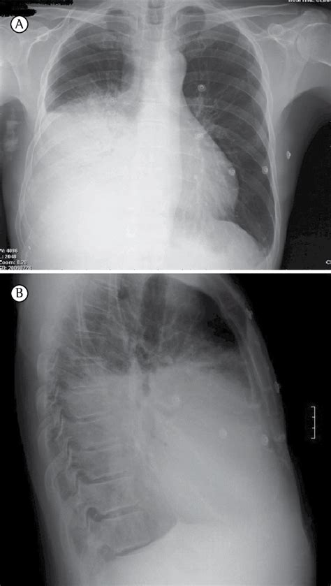 Chest X Ray Showing An Opacity In The Middle And Lower Fields Of The Download Scientific