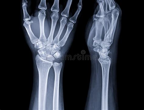 X Ray Image Of Wrist Joint For Diagnosis Rheumatoid Arthritis Stock