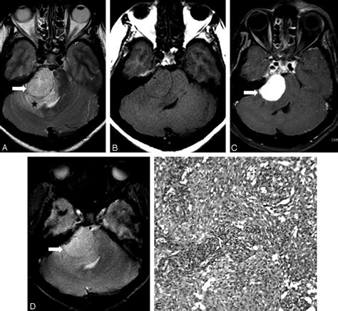 Intratumoral Microhemorrhages On T2 Weighted Gradient Echo Imaging