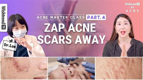 Acne Scar Treatment In Korea Fraxel Lasers Microneedling And Home Care