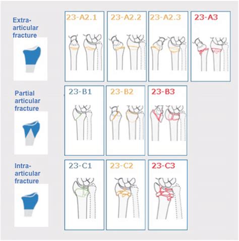 Schematic Illustration Of The AO OTA Classification System For Distal Download Scientific