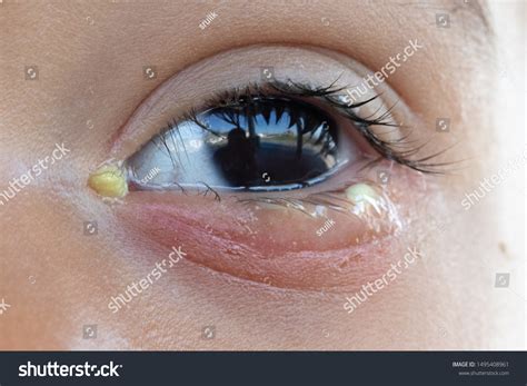 Gross Eye Infections