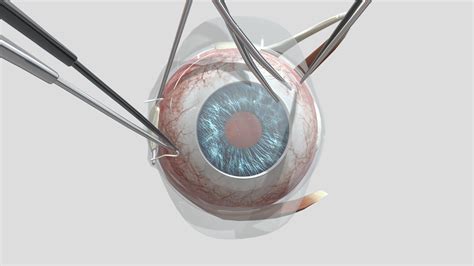 Scleral Buckle Step 1 3d Model By Holoxica 93560df Sketchfab