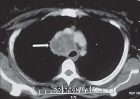Necrotic Mediastinal Lymph Node Enlargement In A Middle Aged Female