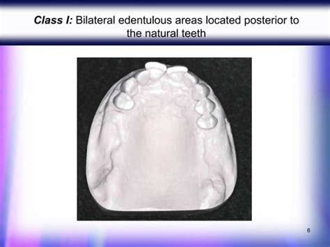 Classification Of Partially Edentulous Arches