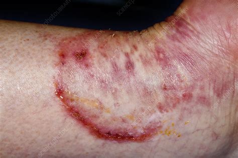 Fungal Skin Infection Stock Image C0263310 Science Photo Library