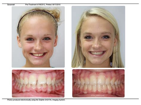 Orthodontist In Beaufort Near Hilton Head Bluffton Walterboro Winning Orthodontic Smiles