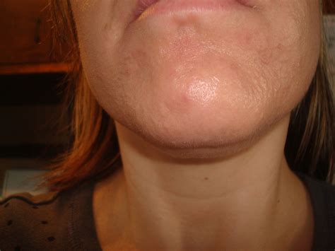 Bumps On Chin Not Acne How To Get Rid Of White Red Bump On Chin My