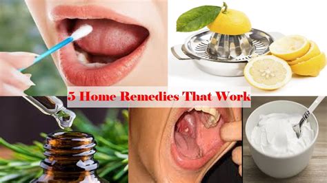 How Do You Remove Tonsil Stones At Home 5 Home Remedies That Work