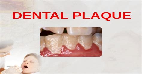 Dental Plaque Presentation Pptx Powerpoint