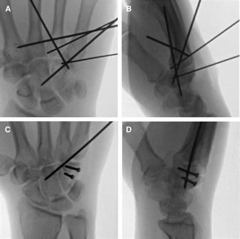 Operative Management Of Hamate Body Fractures A Ap Wrist View Of