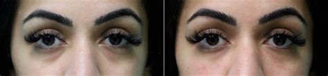 Tear Trough Under Eye Injections Before And After Photos Page 2 Of