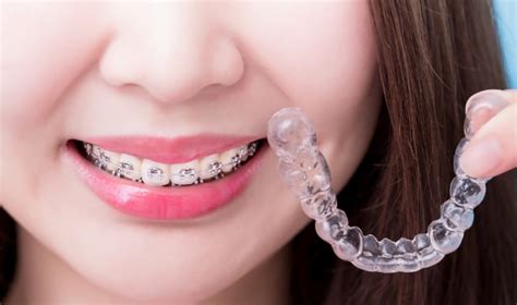 Teeth Braces North Sydney Dentistry