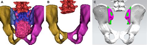 Frontiers A Novel Three Dimensional Printed Biomechanically Evaluated