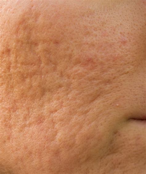 Acne Scars Treatment Mclean Potomac Dermatology