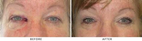 Eyelid Skin Cancer Excision Before And After Photo Gallery