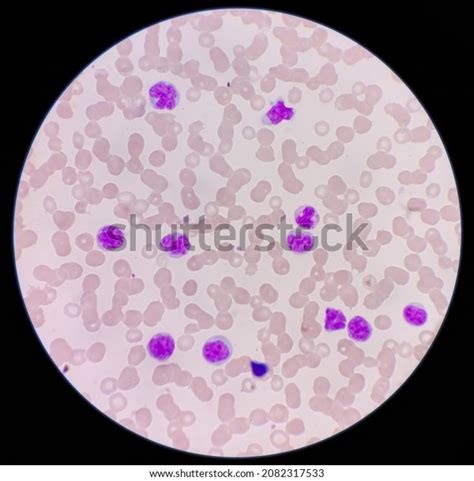 Microscopic Image Showing Thrombocytopenia Leukocytosis Monocytes Stock