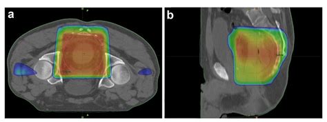 A B Radiotherapy Plan In The Treatment Of Rectal Cancer Patient In A