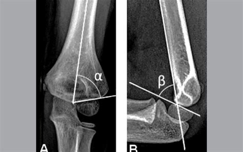 Radiographic Parameters Used For Evaluation Of Elbows A The Baumann