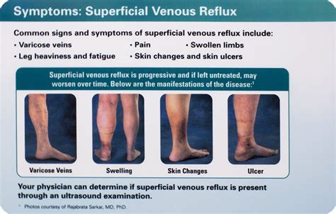 Understanding Venous Reflux The Cause Of Varicose Veins And Venous Leg