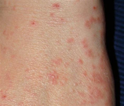 What Does Scabies Look Like On African American Skin What Does