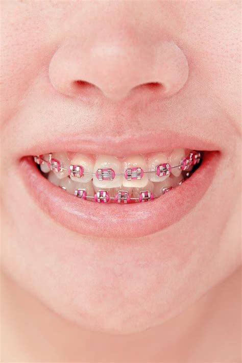 4 Things To Keep Out Of Your Mouth With Braces