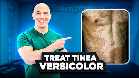 How To Treat Tinea Versicolor And Keep It From Coming Back 🛑 See My