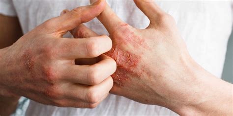 What Is Eczema And How Can It Affect You Apex Dermatology And Skin