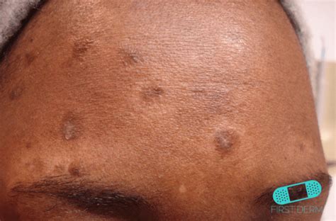 10 Most Common Black Skin Conditions And Their Treatment First Derm