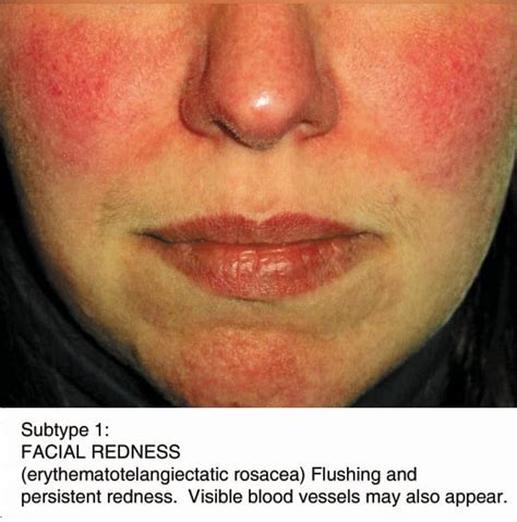 Rosacea Causes Triggers Symptoms Treatment Options Candie Anderson