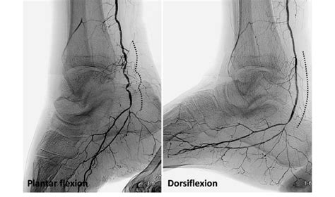 Selective Digital Angiogram Of The Posterior Tibial Artery Note That