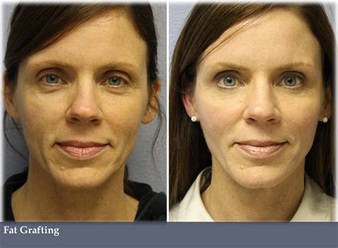 Fat Grafting Vargas Face And Skin Center