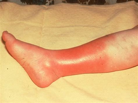 Cellulitis Symptoms Causes Pictures And Treatment