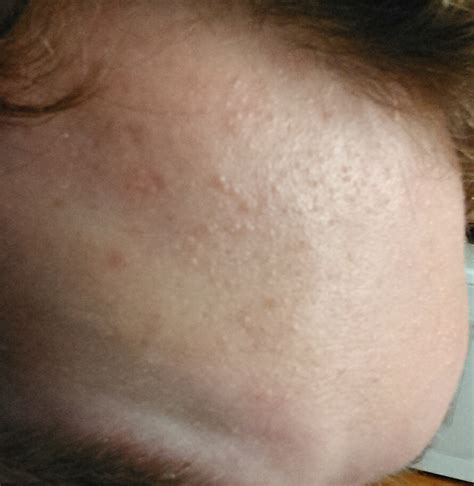 Small Colorless Bumps All Over Forehead General Acne Discussion