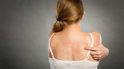 eczema cauze simptome tratament consultatii online getvig health