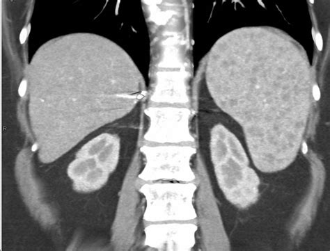 Sarcoidosis Of The Spleen As Well As Dilated Pancreatic Duct Spleen