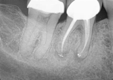 Vertical Root Fractures The Diagnostic Dilemma And Hidden Menace The