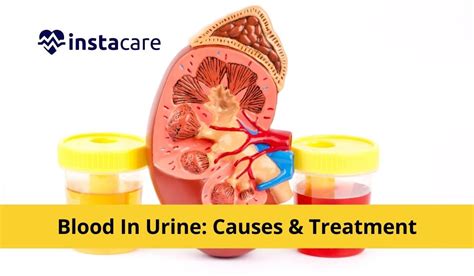Blood In The Urine Hematuria Symptoms Causes And Treatment