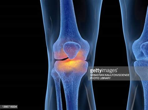 Tibia Fibula Photos And Premium High Res Pictures Getty Images
