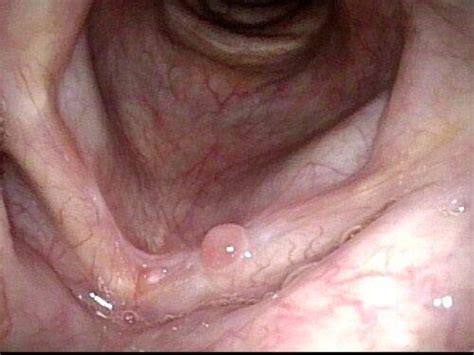 Early Vocal Fold Cancer