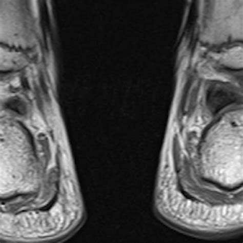 The muscles acting on the foot can be divided into two distinct groups; Charcot-Marie-Tooth, MRI | Eurorad